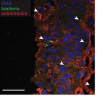 Bladder biopsy showing embedded bacteria